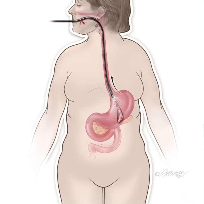 ORBERA-Procedure-Removal-Step-6